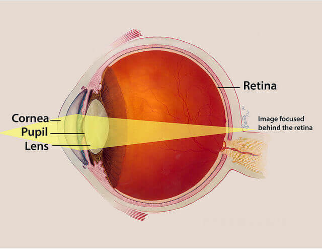 What is Presbyopia and What are My Options?